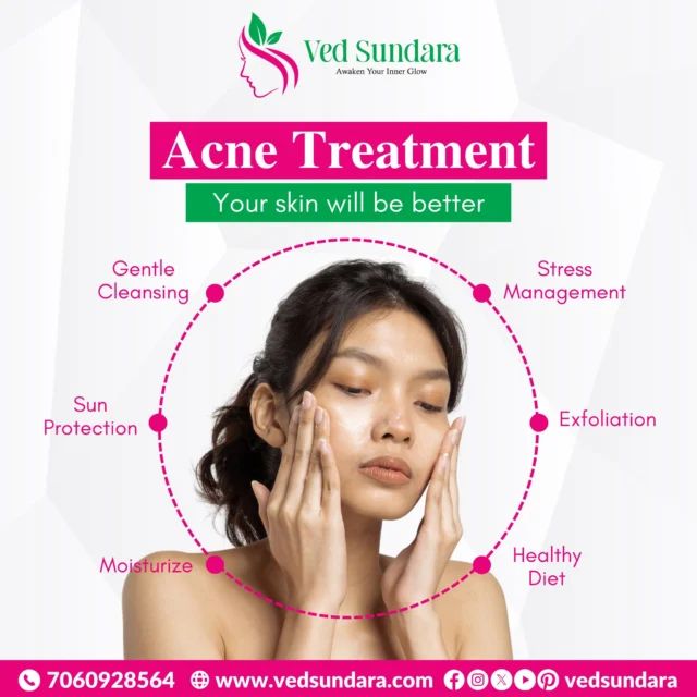Say hello to smoother, brighter, healthier skin.
Ved Sundara offers a trusted Ayurvedic approach to acne that works from within.
🌟 Because your skin deserves care that’s clean, calm, and chemical-free.

📲 Book your consultation: 7060928564
🔗 Explore more: www.vedsundara.com

#VedSundaraGlow #AcneCare #AyurvedicBeauty #NaturalHealing #SkinConfidence #NoAcneYesGlow #SkincareWithSoul #GlowFromWithin #AyurvedaLove #SkincareThatWorks